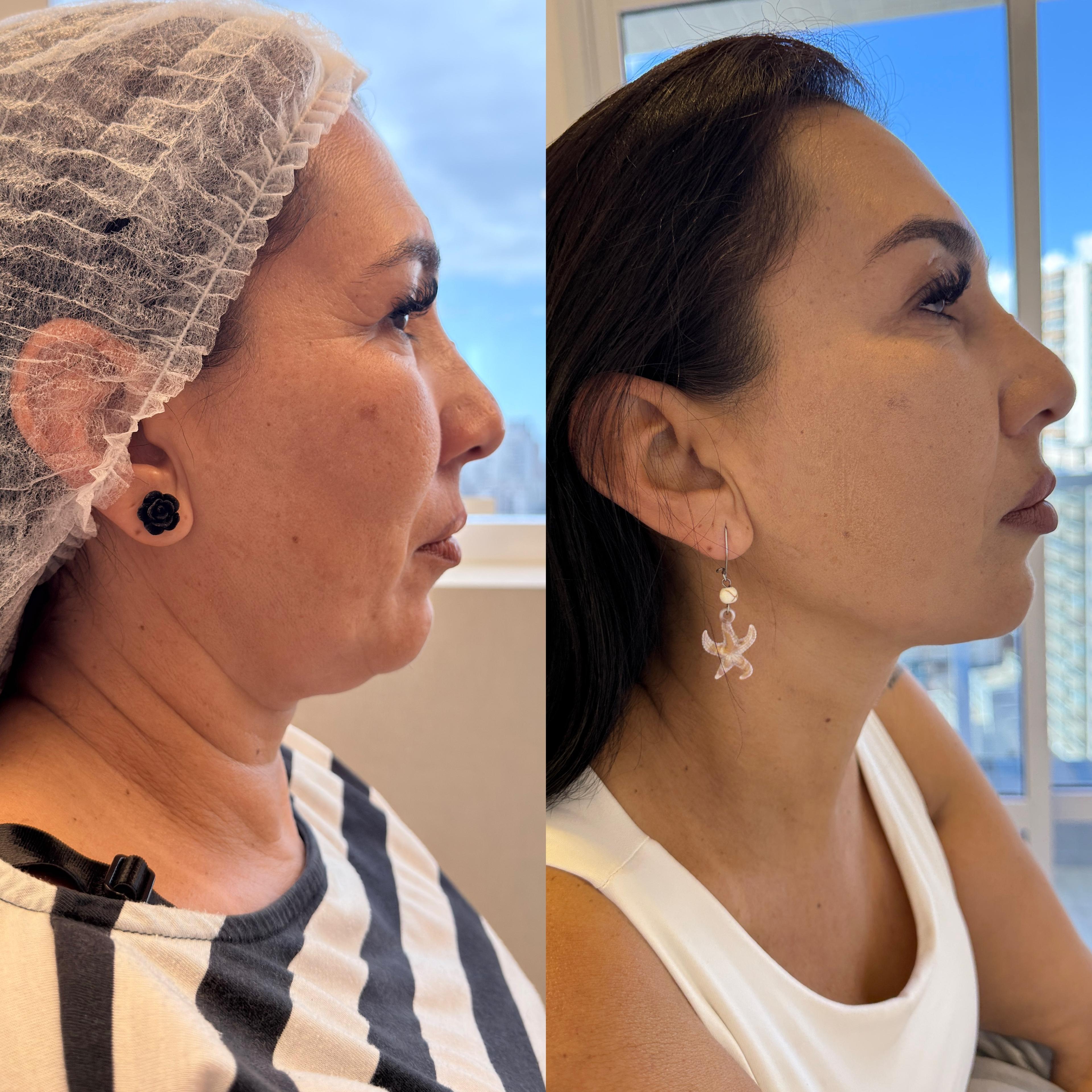 Ultrassom Microfocado